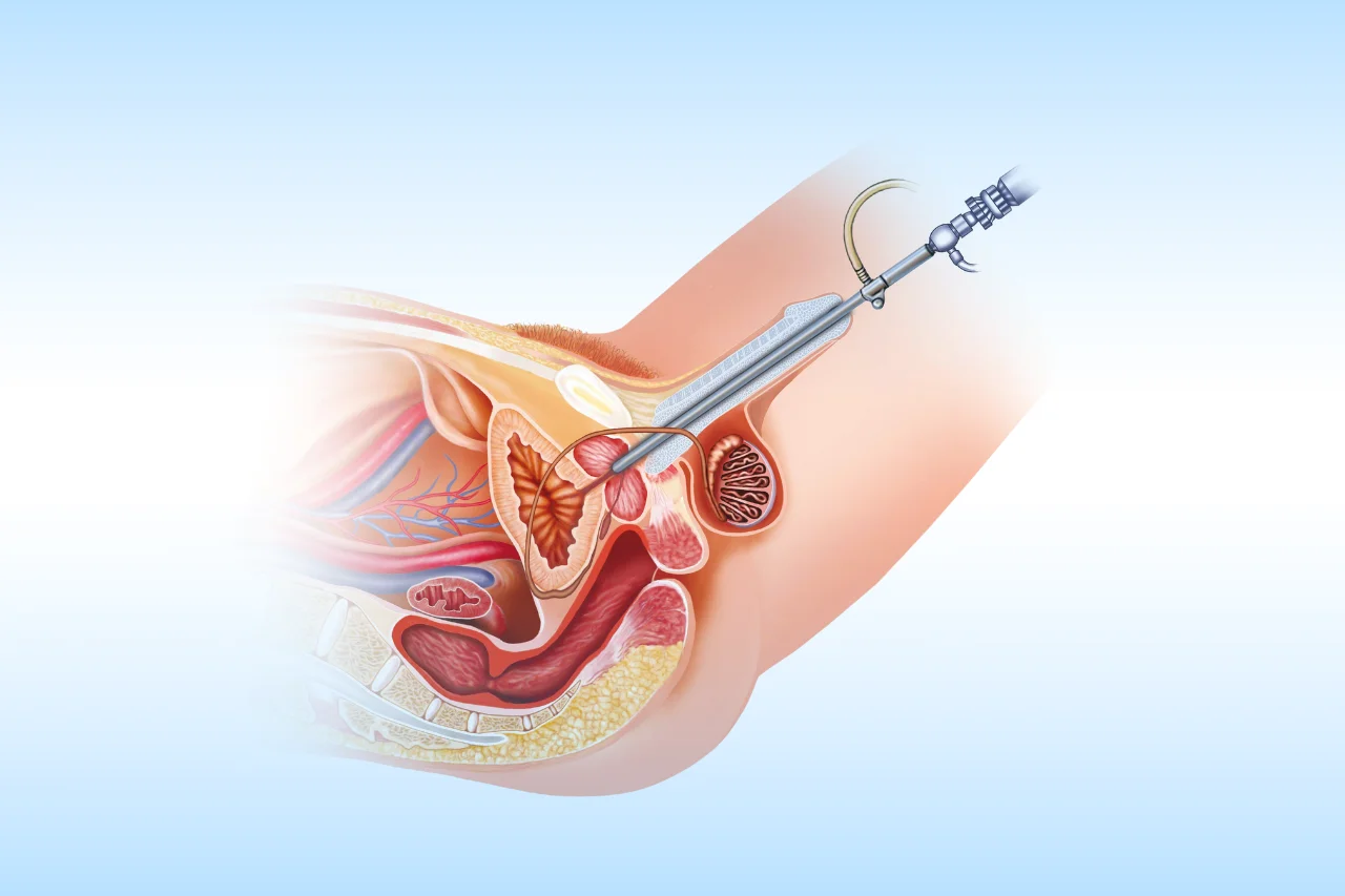 urethral stricture - dr-aman-chandra hyderabad